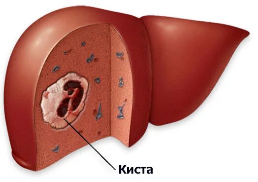 Рак печени фото Опасны ли кисты в печени? - Хирург К. В. Пучков