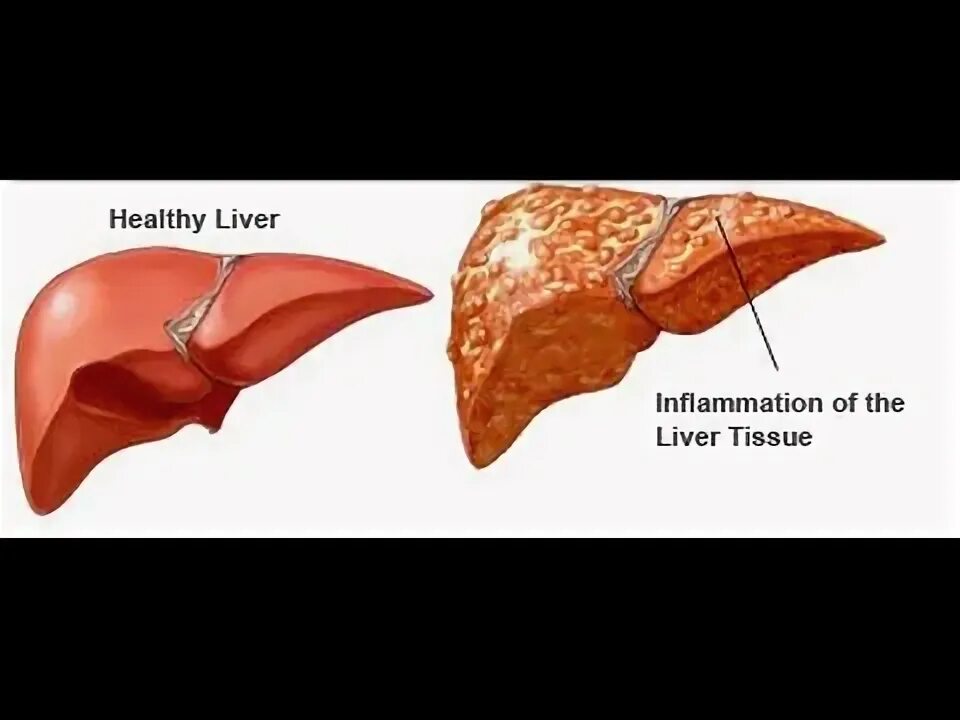 Рак печени фото HEPATITIS DIABETICA - YouTube