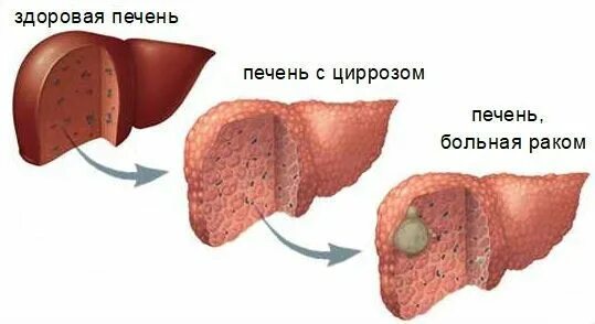 Рак печени фото Билиарный цирроз печени: причины, симптомы и лечение в статье гепатолога Глазков