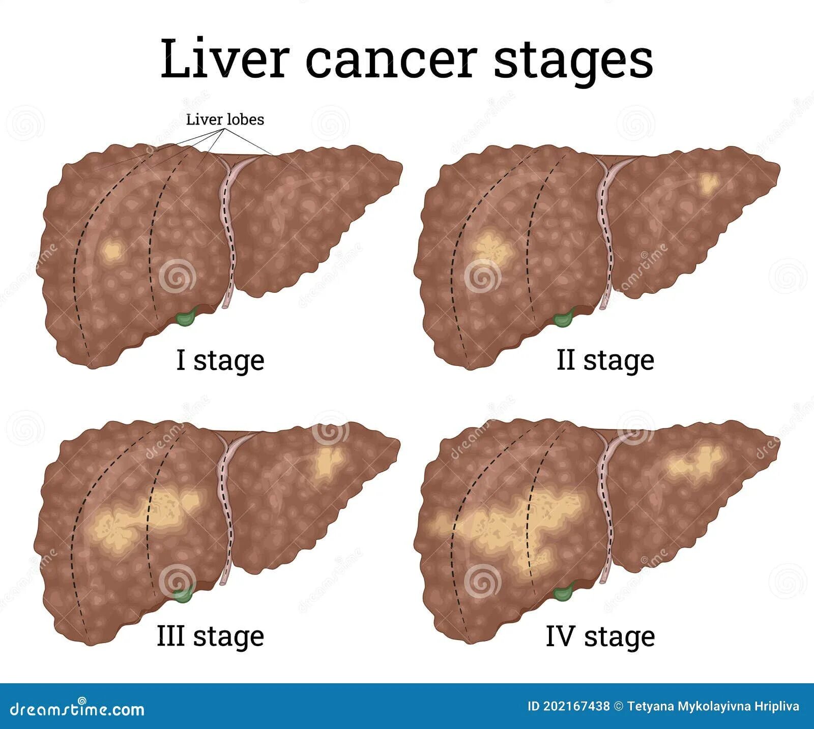 Рак печени фото Liver cancer stages stock vector. Illustration of destruction - 202167438