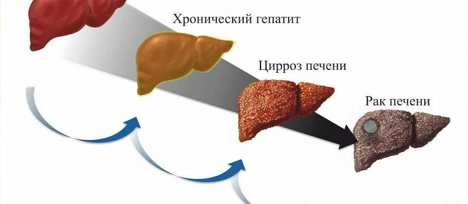 Рак печени фото 28 юля - Всемирный день борьбы с гепатитом - Центр охраны материнства и детства 