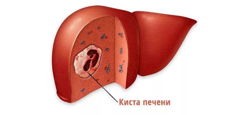 Рак печени фото больных Киста Печени Цена Киев ⚕ Удаление Кисты Печени