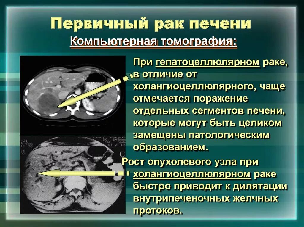 Рак печени фото больных Рак печени первая стадия симптомы: найдено 76 картинок