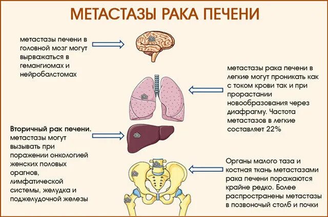 Рак печени фото людей Метастазы в печени: симптомы перед смертью, прогноз срока жизни и лечение. ПРО В