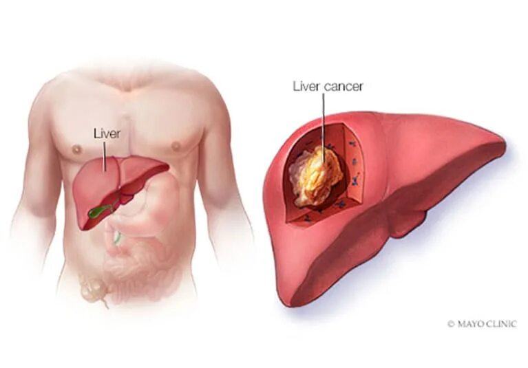 Рак печени фото людей Use of comprehensive multigene panel testing for patients with HBC - Mayo Clinic