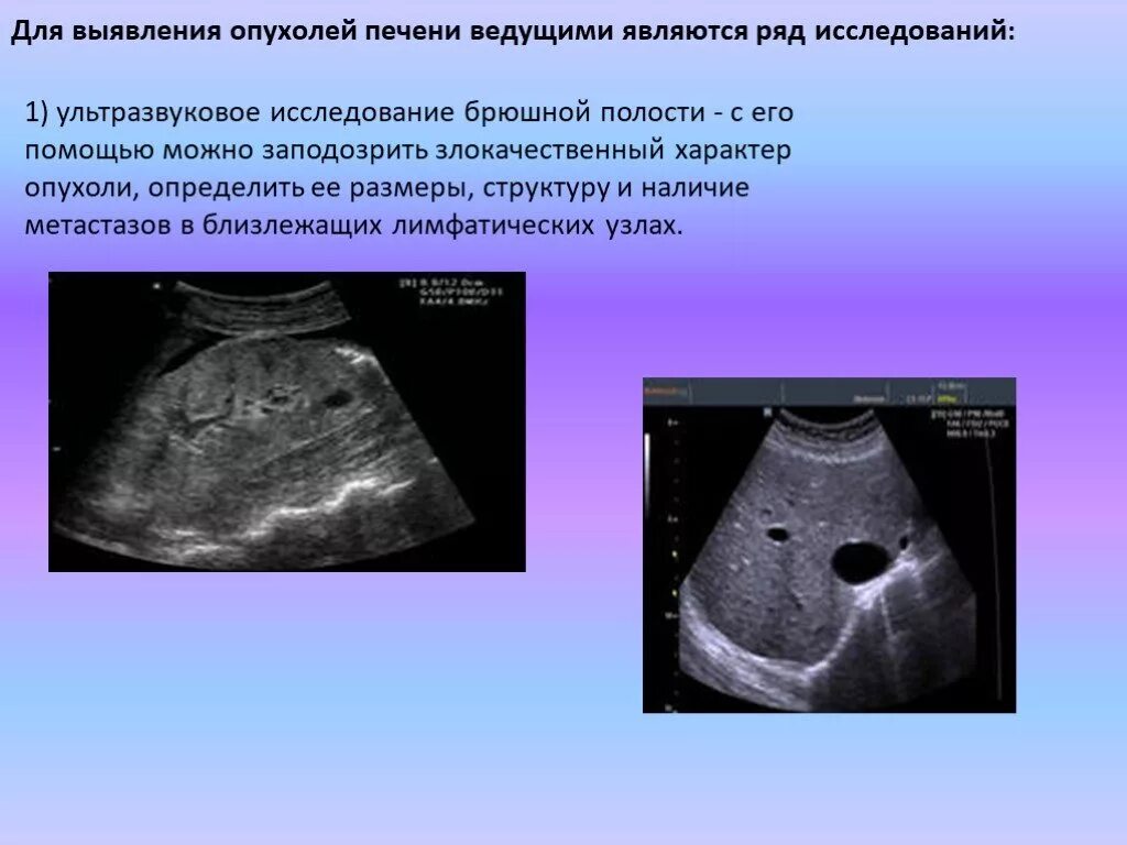 Рак печени на узи фото На узи брюшной полости можно увидеть рак - найдено 88 картинок