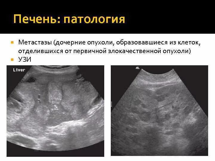 Рак печени на узи фото Узи показывает метастазы - найдено 87 картинок