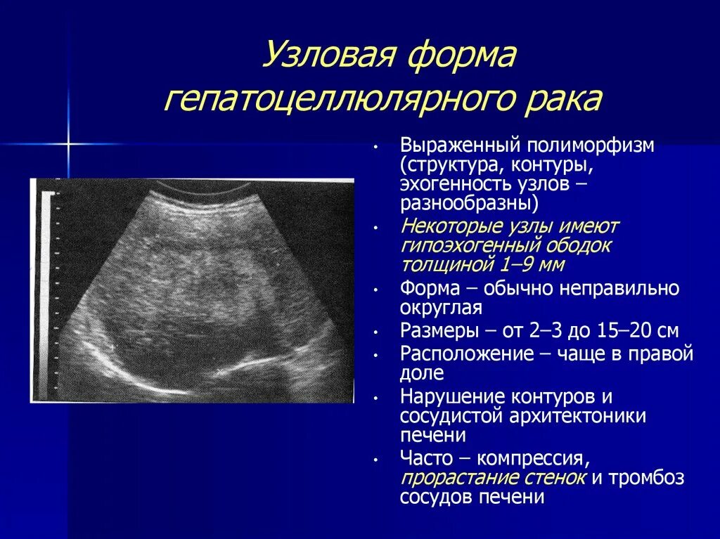 Рак печени на узи фото Очаговое образование с четкими контурами