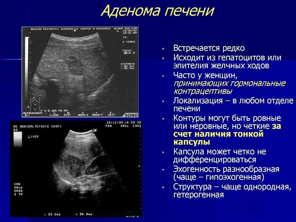 Фото рак печени на УЗИ