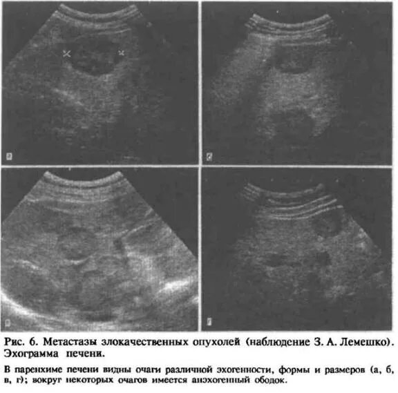Рак печени на узи фото Очаг неоплазии
