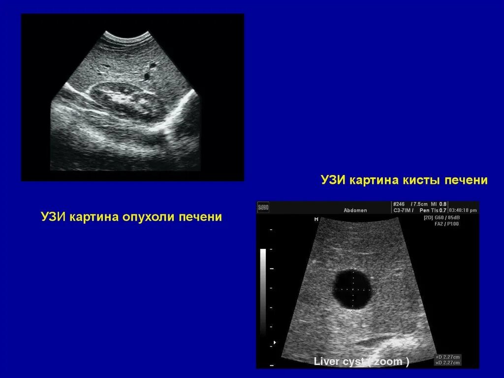 Рак печени на узи фото Рак печени узи картина
