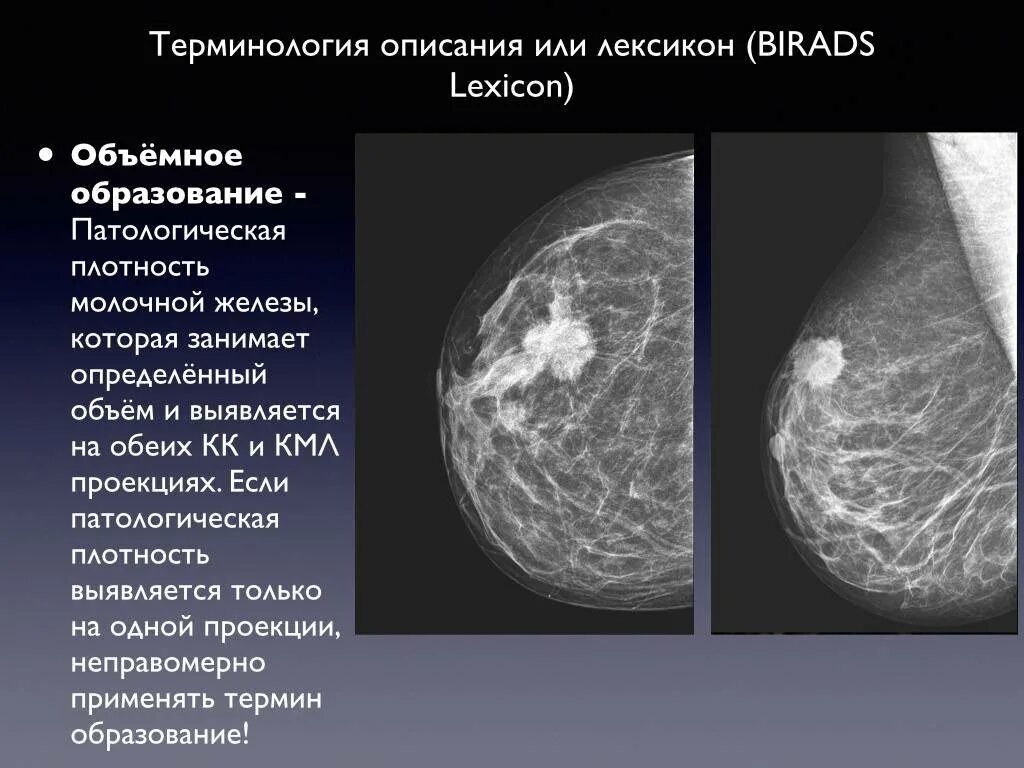 Рак педжета молочной железы фото симптомы Маммография после рентгена - найдено 89 картинок