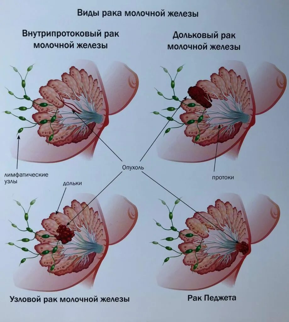 Рак педжета молочной железы фото симптомы Злокачественные образования молочной железы - Ежиков Александр Леонидович