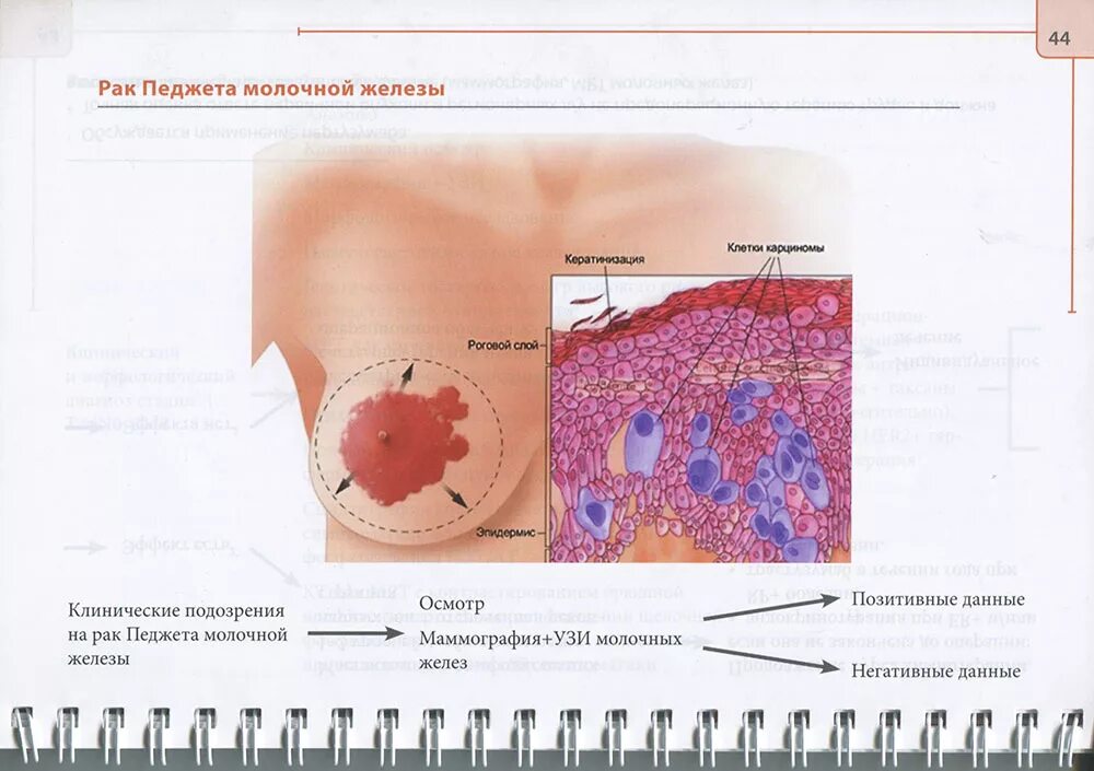 Рак педжета молочной железы фото симптомы Книга "Справочник по лечению первичного рака молочной железы" Сайт мед книг