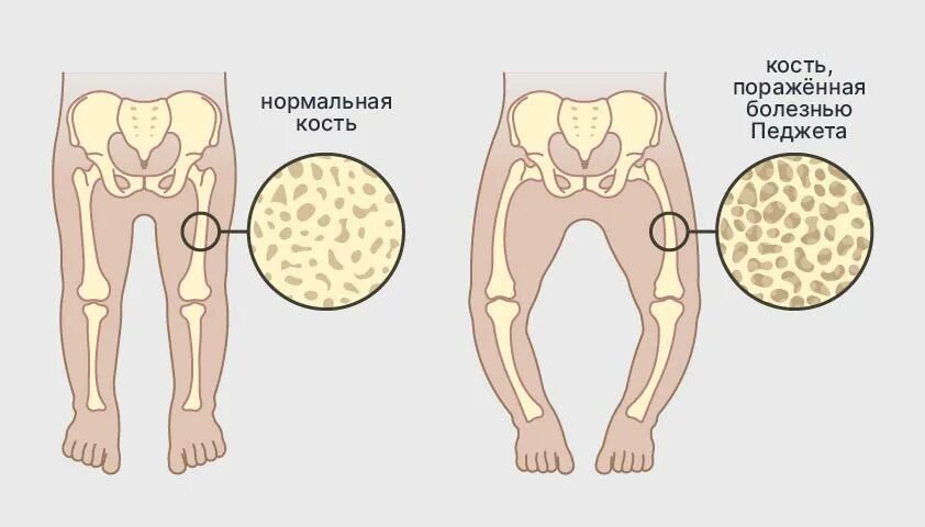 Рак педжета симптомы фото Болезнь Педжета (деформирующий остеит) - причины и симптомы