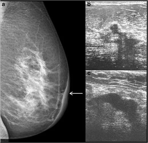 Рак педжета симптомы фото Spectrum of Imaging Findings in Paget’s Disease of the Breast—A Pictorial Review