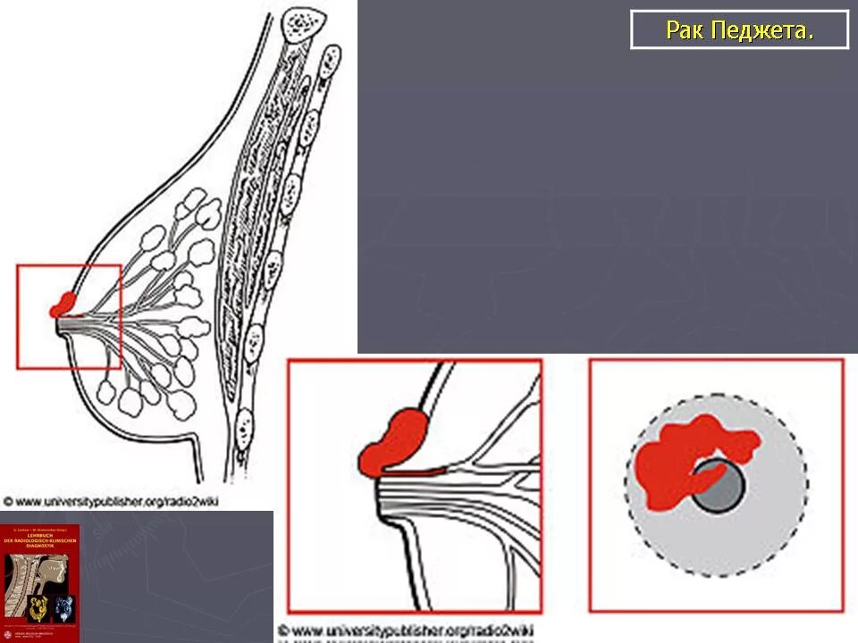 Рак педжета симптомы фото Молочная железа. Онк. Зл. Педжета рак. + Портал радиологов