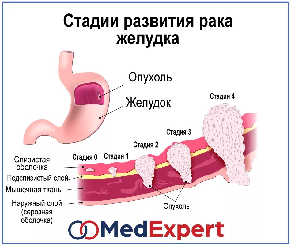 Рак первой стадии фото Первые признаки раннего рака желудка - найдено 89 картинок