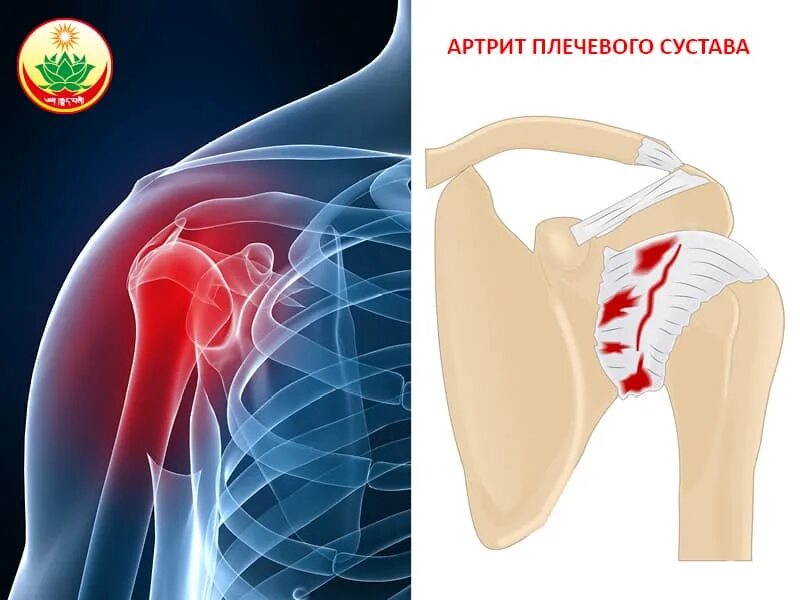 Рак плечевого сустава симптомы фото и лечение Артрит плечевого сустава: симптомы, причины, диагностика и методы лечения болезн