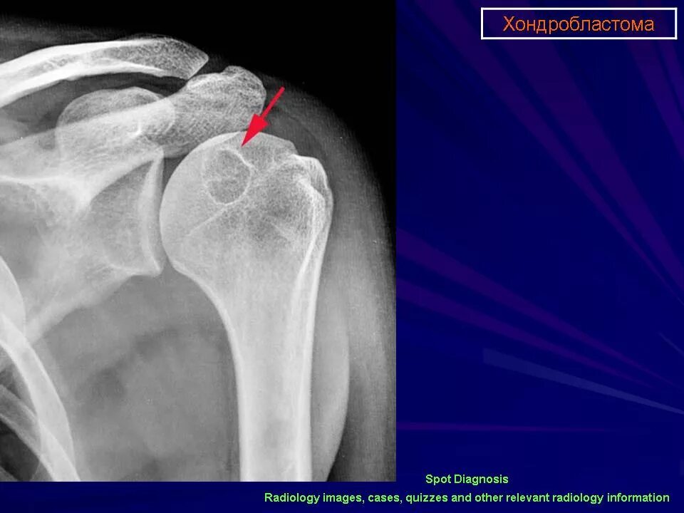 Рак плечевого сустава симптомы фото и лечение Плечевая кость, Боли. Rg Портал радиологов