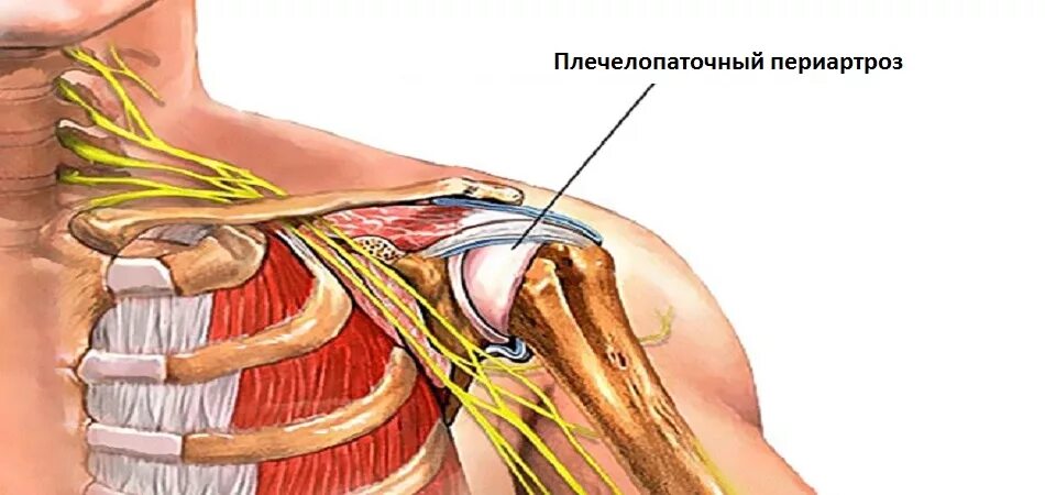 Рак плечевого сустава симптомы фото и лечение Плечелопаточный периартроз: симптомы и лечение в Москве