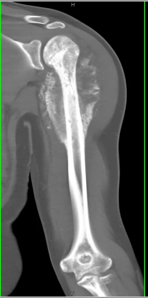 Рак плечевой кости фото Рак плеча: найдено 87 изображений