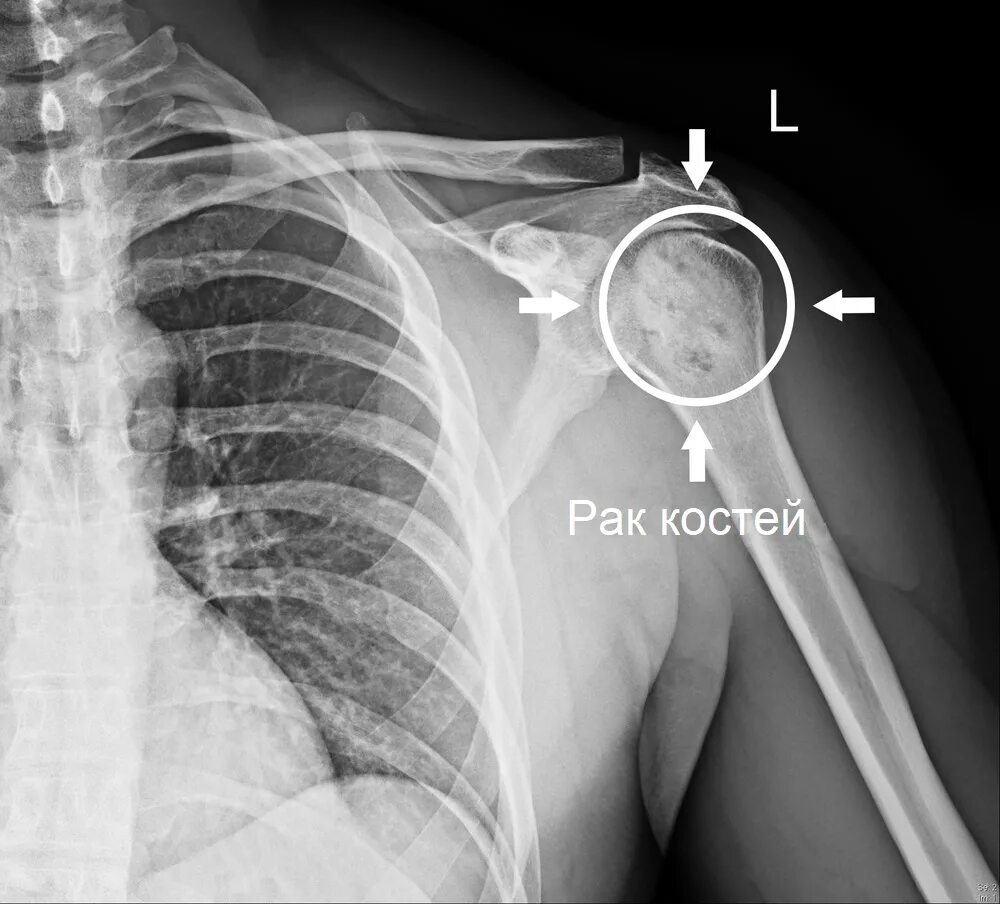 Рак плечевой кости фото Рак костей: первые симптомы, фото, лечение, стадии и прогноз жизни