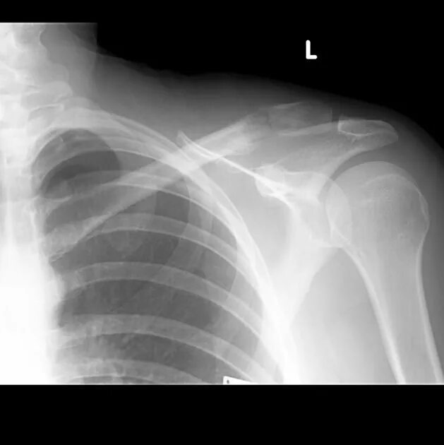 Рак плечевой кости фото Pin on X Rays