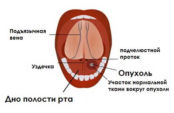 Рак полости рта фото симптомы Пластика уздечки языка - причины и признаки патологии, показания к операции