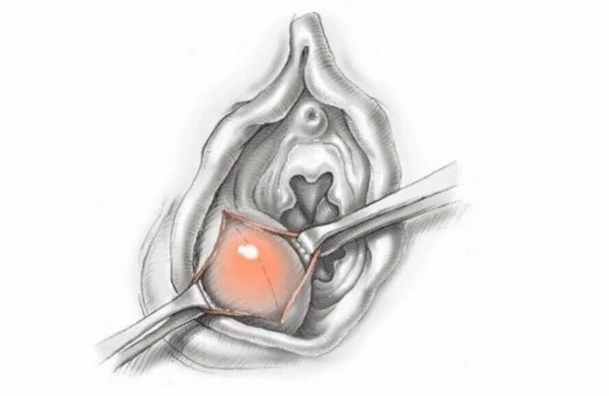 Рак половой губы симптомы фото Киста бартолиновой железы