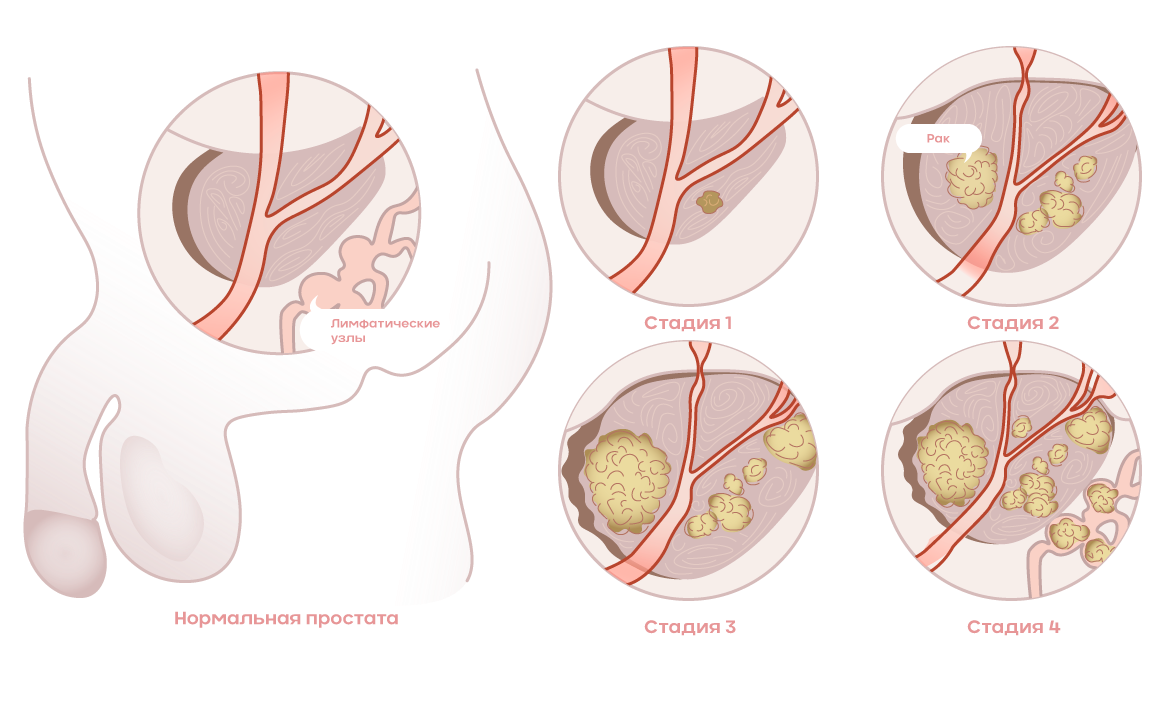 Рак предстательной железы симптомы фото Внимание, онкология!