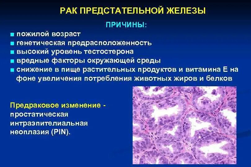 Рак предстательной железы симптомы фото Рак простаты причины