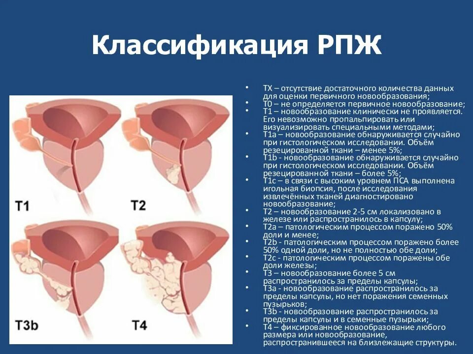 Рак предстательной железы симптомы фото Дгпж 1 ст