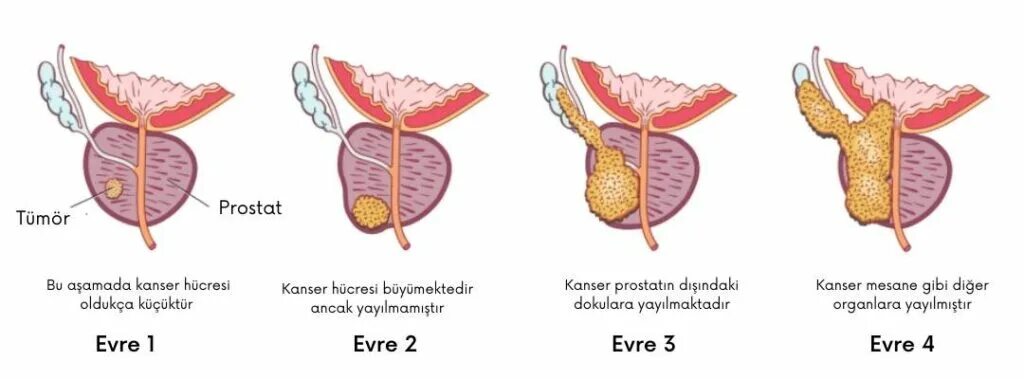 Рак предстательной железы симптомы фото Prostat Kanseri Nedir ? - Prof. Dr. Serdar Aykan