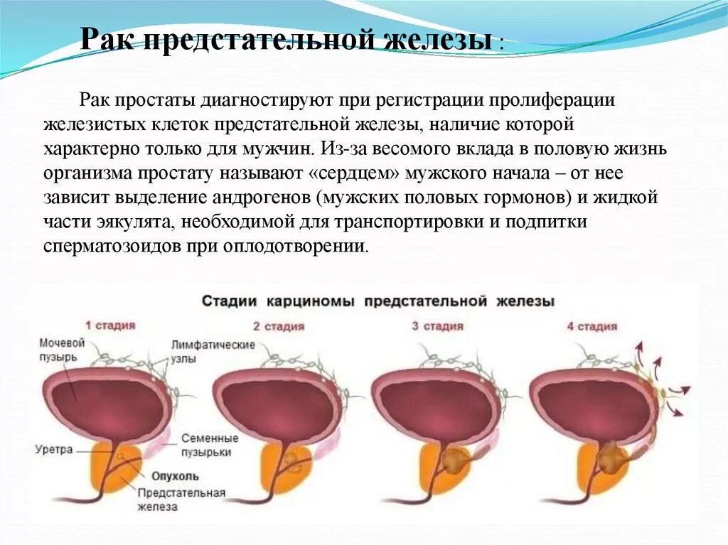 Рак предстательной железы симптомы фото Признаки рака предстательной