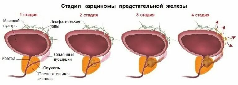 Рак предстательной железы симптомы фото Рак предстательной железы