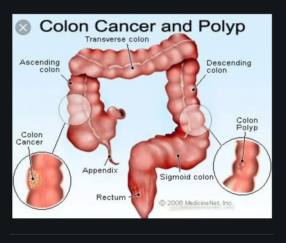 Рак признаки и симптомы фото Рак кишечника признаки и симптомы