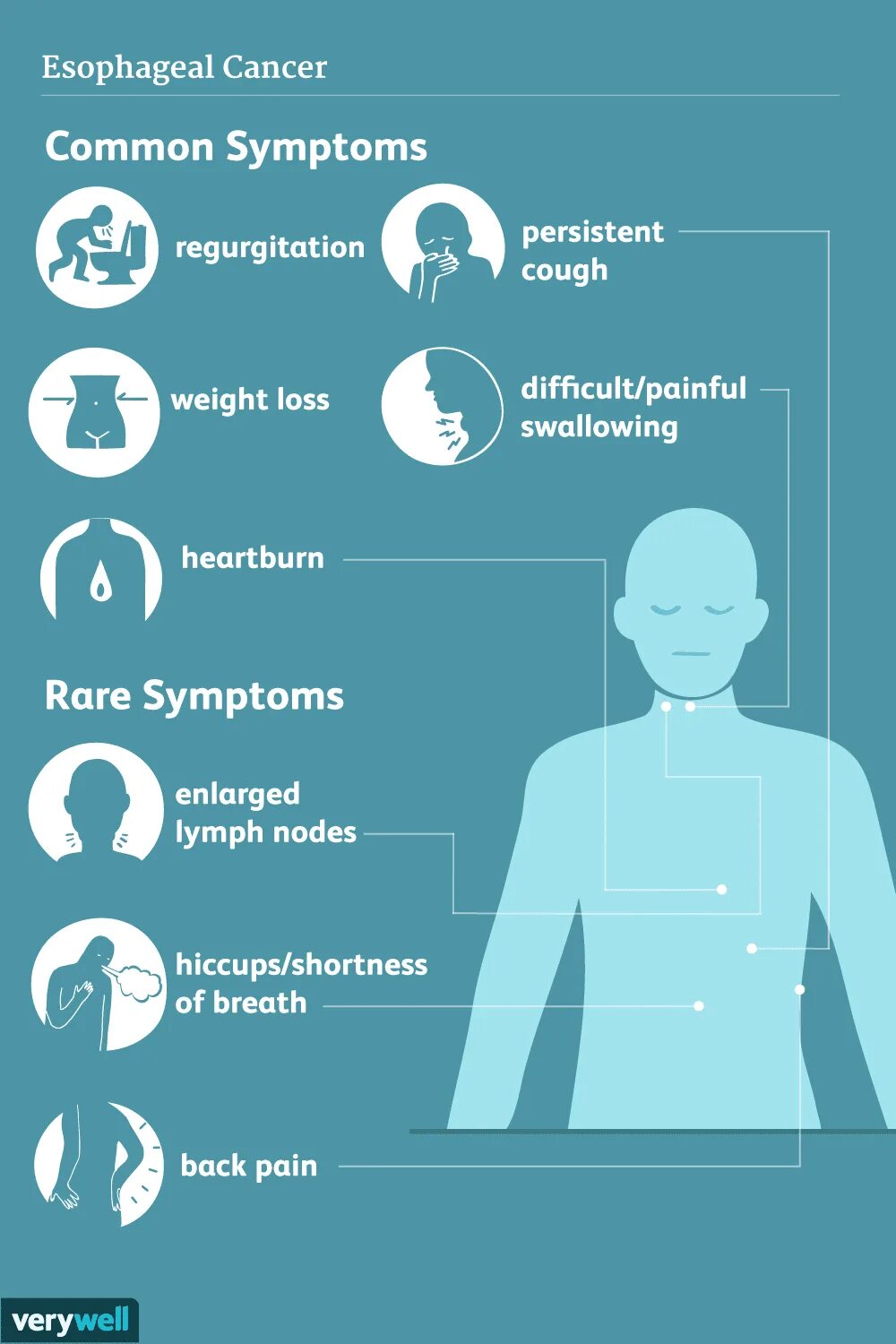 Рак признаки и симптомы фото Esophageal Cancer: Signs and Symptoms