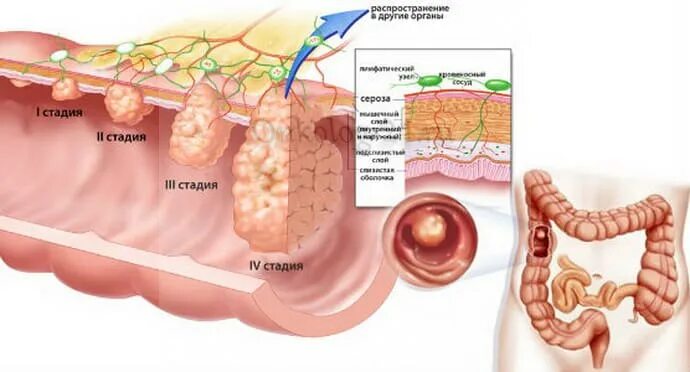 Рак прямой кишки фото снаружи как выглядит Полип в прямой кишке - симптомы и лечение