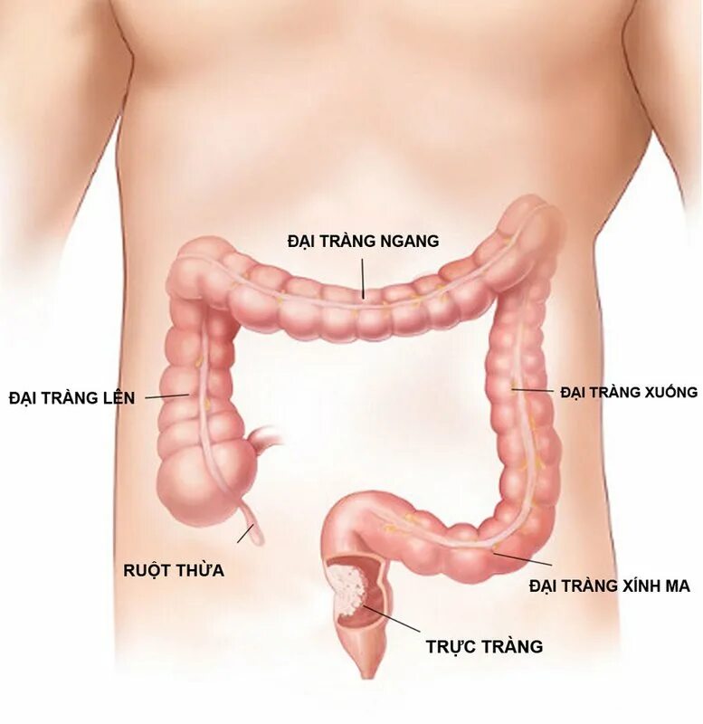 Рак прямой кишки фото снаружи как выглядит Diagnosis and treatment of gastrointestinal bleeding Vinmec