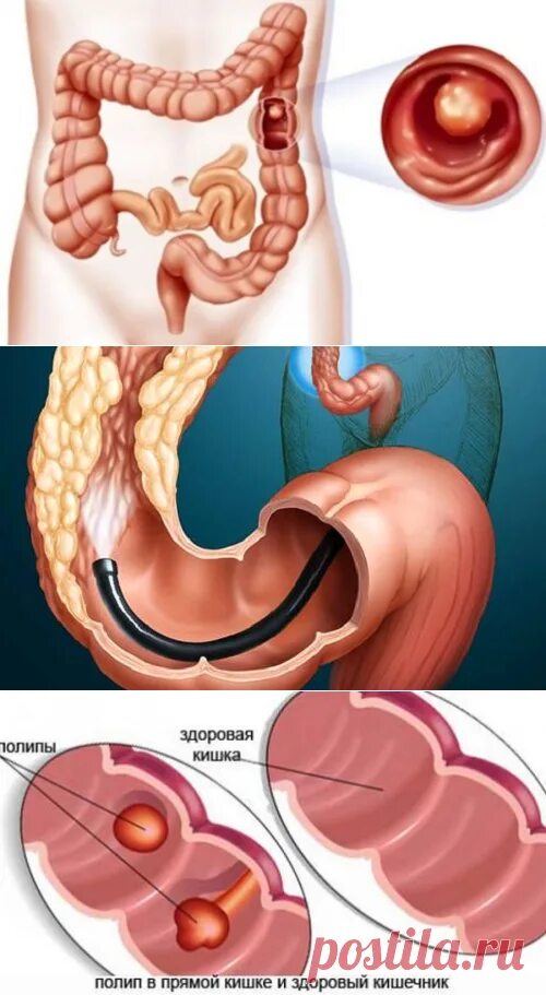 Рак прямой кишки фото снаружи как выглядит Полипы в кишечнике: как их можно обнаружить и удалить? Кладовая здоро лечение бо