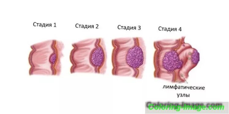 Рак прямой кишки фото снаружи как выглядит ✅ Симптоми раку товстої кишки на ранній стадії - перші ознаки злоякісної пухлини