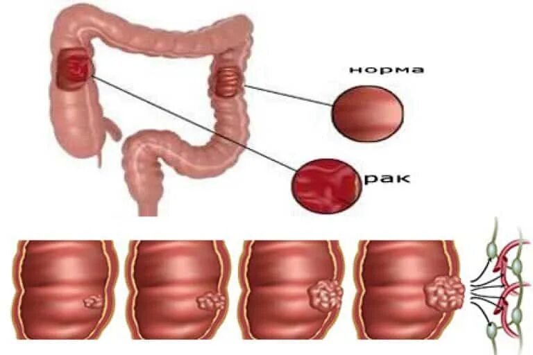 Рак прямой кишки первые симптомы фото Рак кишечника симптомы первые признаки отзывы - найдено 87 картинок