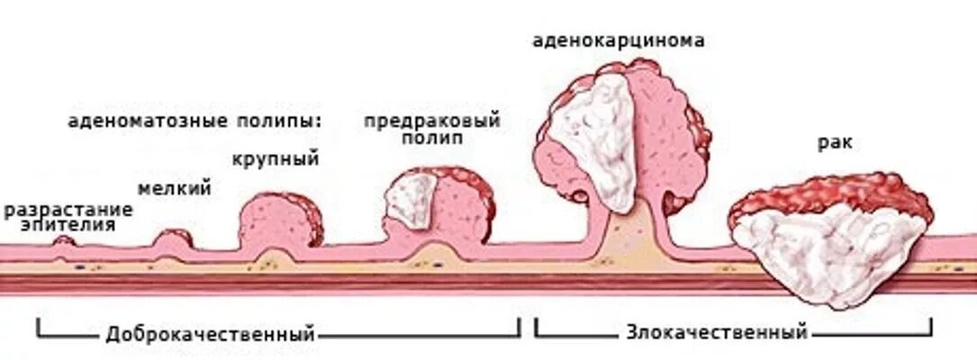 Рак прямой кишки первые симптомы фото Лечение опухоли кишечника в Санкт-Петербурге, стоимость лечения в ПСПбГМУ им. ак