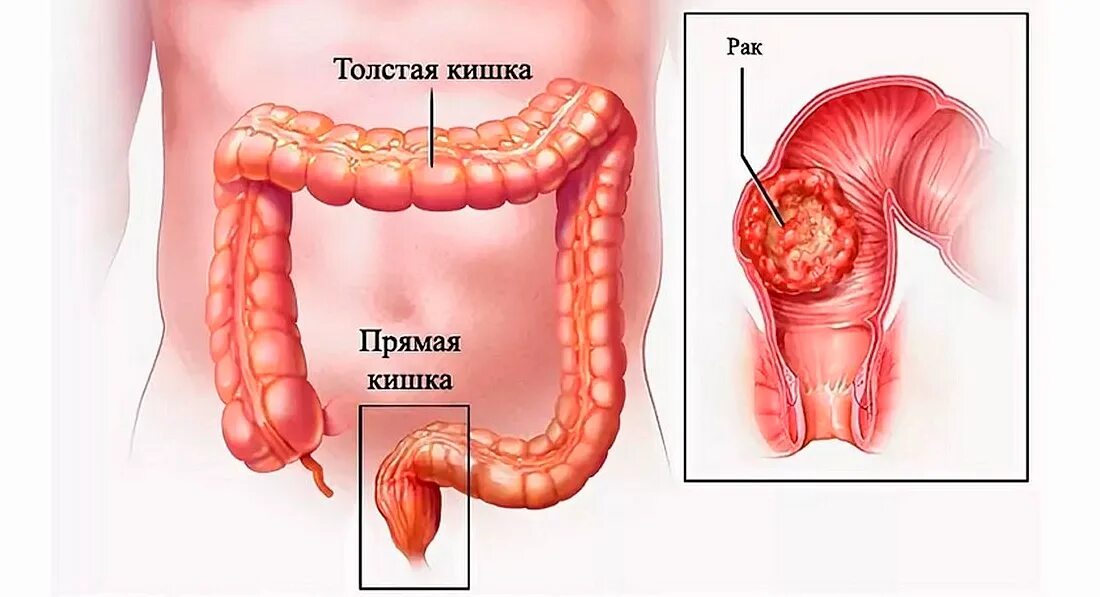 Рак прямой кишки симптомы фото Операция по удалению опухоли в прямой кишке. - Хирург К. В. Пучков