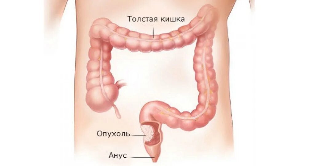 Рак прямой кишки симптомы фото Рак толстой кишки, симптомы при карциноме толстой кишки