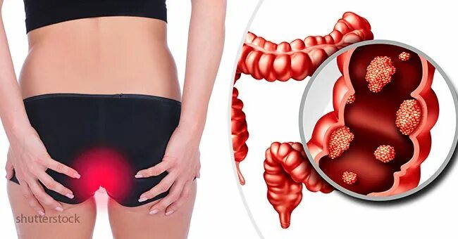 Рак прямой кишки симптомы у женщин фото Most of these symptoms are usually ignored or mistaken for something minor. This