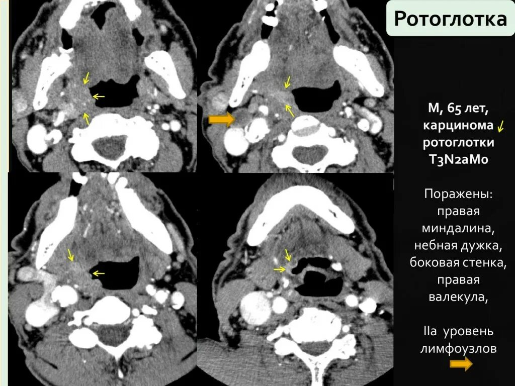 Рак ротоглотки симптомы и фото КТ-диагностика злокачественных опухолей ротовой полости, глотки, гортани