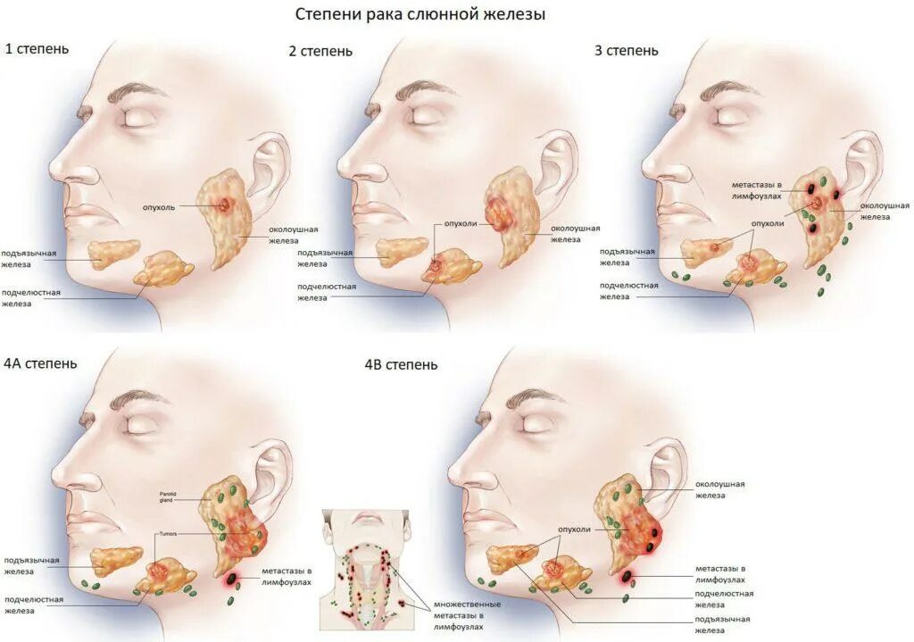 Рак щеки начальная стадия фото Рак слюнной железы: симптомы, лечение, прогноз жизни eraminerals.ru