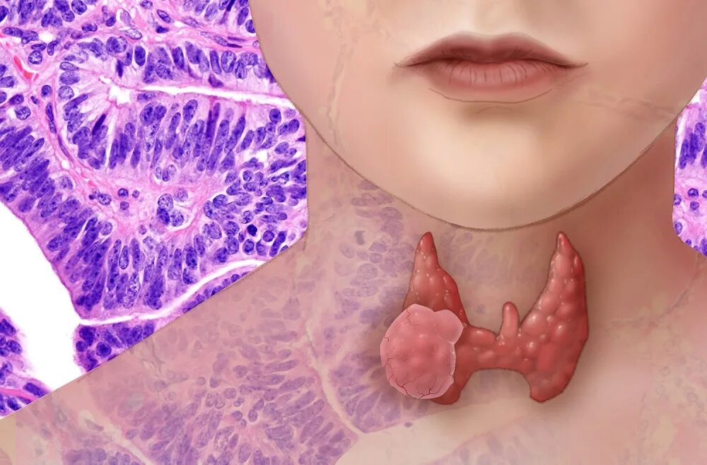 Рак щитовидной железы симптомы у женщин фото Benign soft tissue neoplasms - Clinic "K+31"